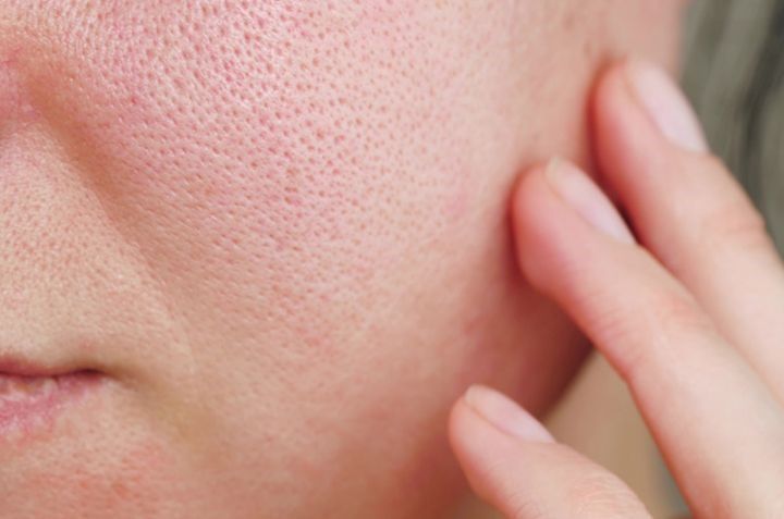 lỗ chân lông to sau mùa hè nắng gắt